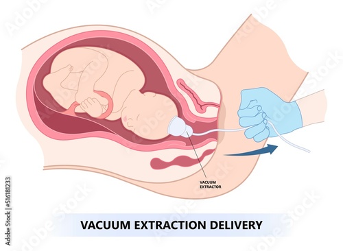 Vacuum assisted delivery the procedure in medical labor to pull baby from uterus fetal c section scalp edema occiput anterior pain facial palsy skull fracture photo