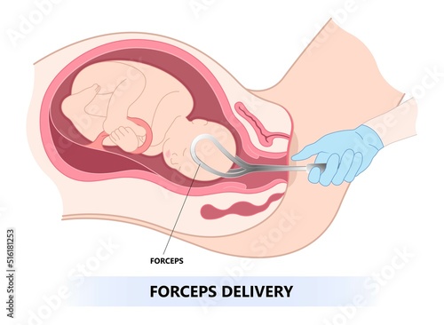forceps assisted delivery the procedure in medical labor to pull baby from uterus fetal Vacuum and c section scalp edema occiput anterior pain facial palsy skull fracture