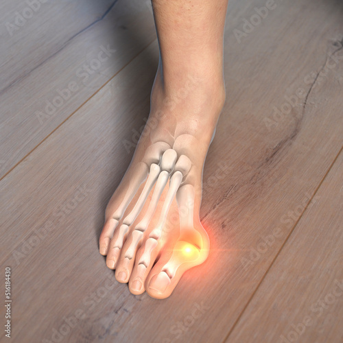 Toe deformation, also known as hallux valgus, or bunion, illustration photo