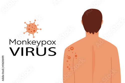 Monkeypox virus concept. Monkey pox banner. Male back affected by blistering rash, scars. Color flat vector illustration isolated on white background