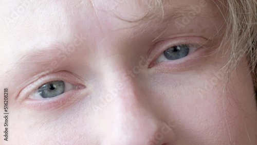 woman with nystagmus, uncontrolled rhythmic movements of the eyeballs, Pathological nystagmus