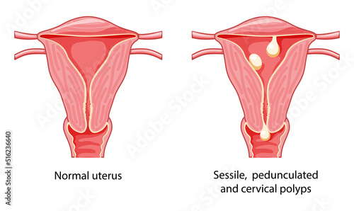 Set of Polyps in the uterus Female reproductive system in cross sections diseases and normal. Front view in a cut. Human anatomy internal organs location scheme, cervix, ovary flat style icon photo