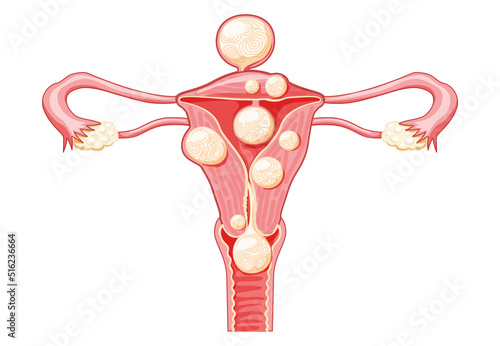 Uterine fibroids Female leiomyomas reproductive system uterus. Front view. Human anatomy medical illustration isolated internal organs location scheme, cervix, ovary, fallopian tube flat style icon