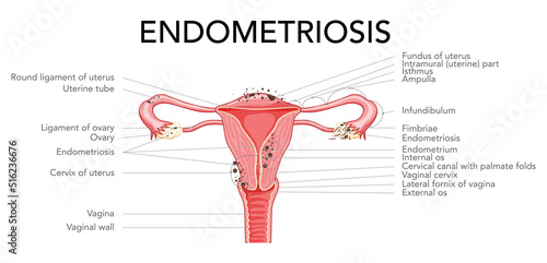 Endometriosis stages Female reproductive system pain uterus diagram with inscriptions text. Front view. Human anatomy internal organs scheme flat style icon vector illustration Realistic flat isolated
