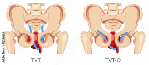 Set of Urinary incontinence tension free vaginal tape TVT versus transobturator tape TOT for female stress urinary incontinence therapy Female system is skeleton pelvis. Human anatomy flat icon
