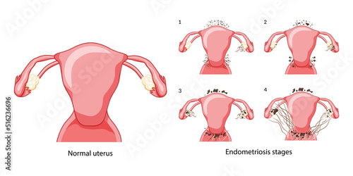 Set of Endometriosis stages Female reproductive system pain pcos tissue cancer cyst uterus. Front view. Human anatomy internal organs location scheme flat style icon. Vector illustration Realistic photo