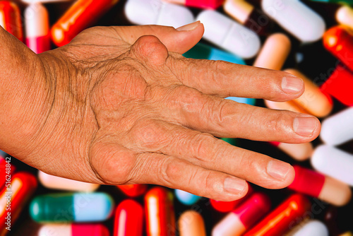 Severe gout in men suffering from joint pain, bone pain, gout, rheumatoid symptoms, radioactive sickness, ill man concept of male osteoporosis, injured bone, injury, pain, arthritis,arm, foot, knee