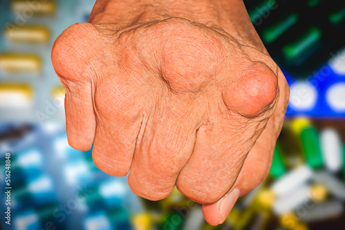 Severe gout in men suffering from joint pain, bone pain, gout, rheumatoid symptoms, radioactive sickness, ill man concept of male osteoporosis, injured bone, injury, pain, arthritis,arm, foot, knee