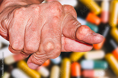 Severe gout in men suffering from joint pain, bone pain, gout, rheumatoid symptoms, radioactive sickness, ill man concept of male osteoporosis, injured bone, injury, pain, arthritis,arm, foot, knee