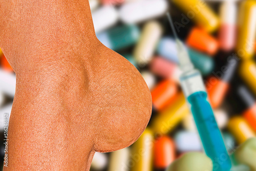 Severe gout in men suffering from joint pain, bone pain, gout, rheumatoid symptoms, radioactive sickness, ill man concept of male osteoporosis, injured bone, injury, pain, arthritis,arm, foot, knee