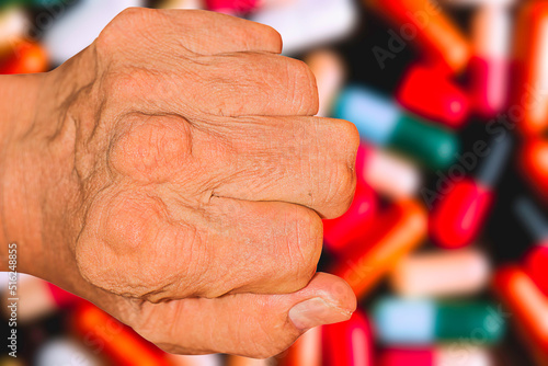 Severe gout in men suffering from joint pain, bone pain, gout, rheumatoid symptoms, radioactive sickness, ill man concept of male osteoporosis, injured bone, injury, pain, arthritis,arm, foot, knee