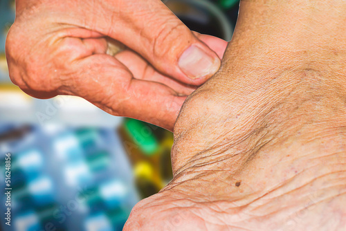 Severe gout in men suffering from joint pain, bone pain, gout, rheumatoid symptoms, radioactive sickness, ill man concept of male osteoporosis, injured bone, injury, pain, arthritis,arm, foot, knee