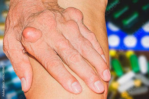 Severe gout in men suffering from joint pain, bone pain, gout, rheumatoid symptoms, radioactive sickness, ill man concept of male osteoporosis, injured bone, injury, pain, arthritis,arm, foot, knee