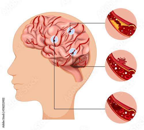 Human with common types of stroke infographic