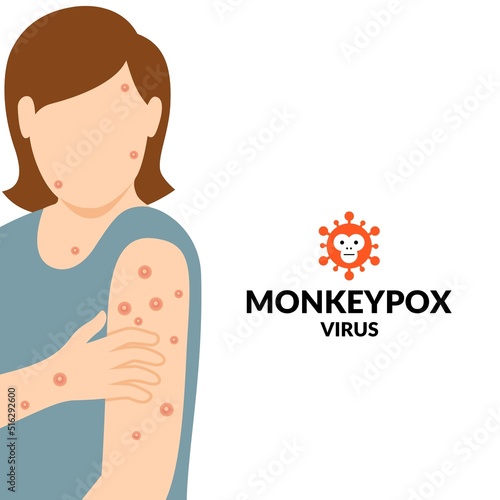 Vector illustration, woman exposed to monkeypox virus, as an educational poster or banner.