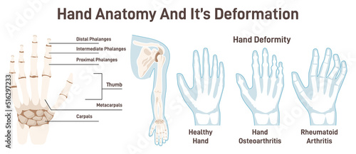 Human hand bones and its deformations. Anatomical structure photo