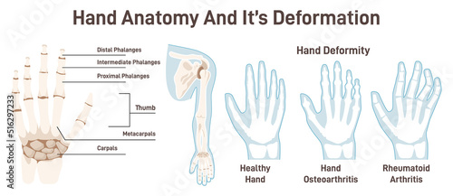 Human hand bones and its deformations. Anatomical structure