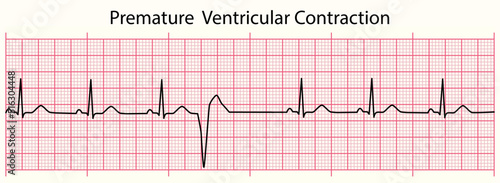 ECG line: Premature Ventricular Contraction in 6 second ECG paper line