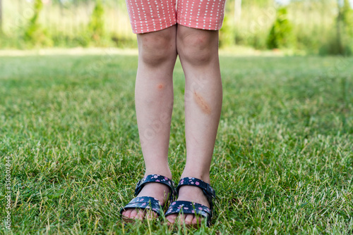 Little child with bruised leg. Bruise on child