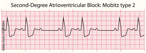 ECG line: Second-Degree Atrioventricular Block: Mobitz type 2 in 6 second ECG paper line