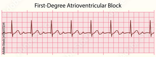 ECG line: First-Degree Atrioventricular Block in 6 second ECG paper line