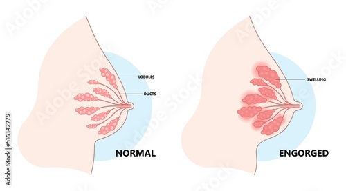 Anatomy of Breast cancer engorged blocked mass milk ducts swollen Breastfeed