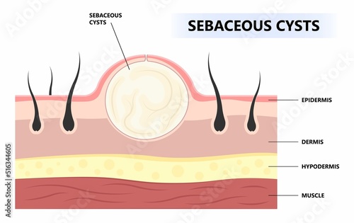 Anatomy of tumor and cancer bumps under the skin of sebaceous cyst pilar boil acne swollen