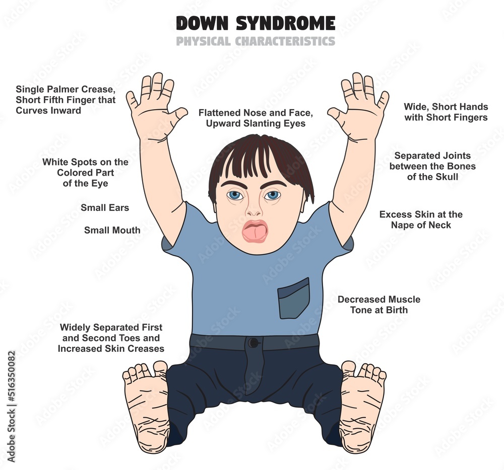 Down syndrome physical characteristic infographic diagram