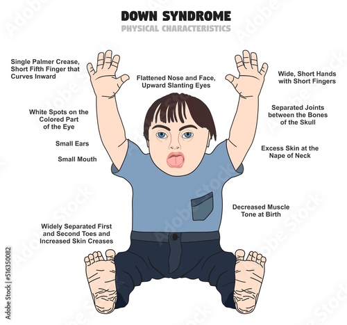 Down syndrome physical characteristic infographic diagram genetic chromosome mutation disorder disease symptoms diagnoses trisomy child growth disability kid baby facial feature vector illustration