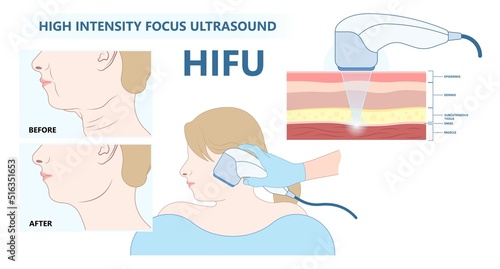 The HIFU therapy or High Intensity Focus Ultrasound face saggy skin treat cell body lift laser hair firm tightening brow toxin droopy double chin scar