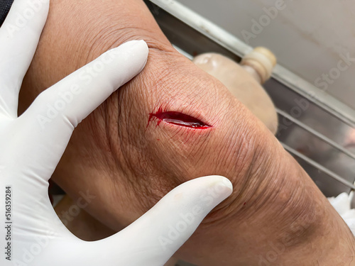 Patient open wound on left leg knees.concept doctor sutures on healing to skin.selective focus  