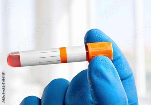 Blood sample for Monkeypox virus test. It is also known as the Moneypox virus, a double-stranded DNA virus and member of Poxviridae family. photo