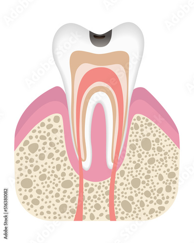 Stage of caries development. Tooth structure in flat style. Tooth decay with enamel. Dental disease realistic vector illustration