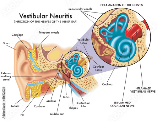 Medical illustration shows the infection and inflammation of the nerves of the inner ear, called vestibular neuritis, with annotations. photo