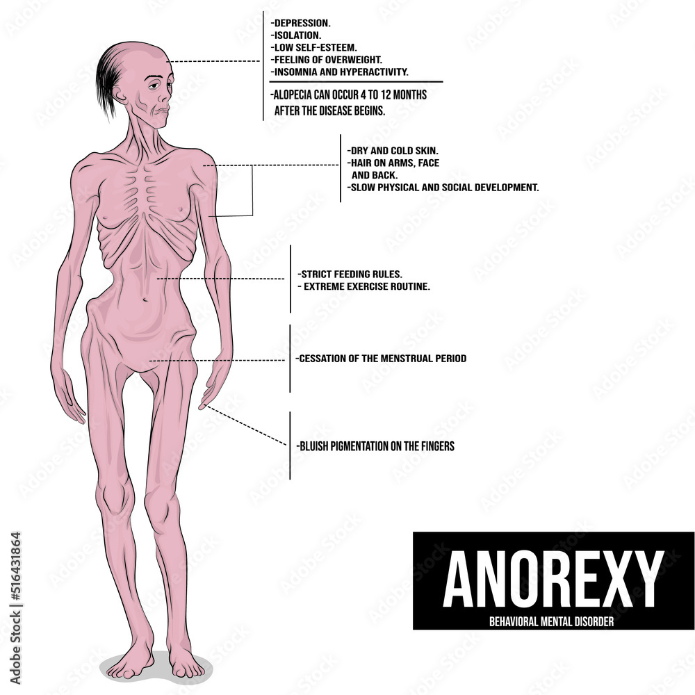 anorexia, an eating disorder that causes people to lose more weight than is considered healthy for their age and height. - obrazy, fototapety, plakaty 