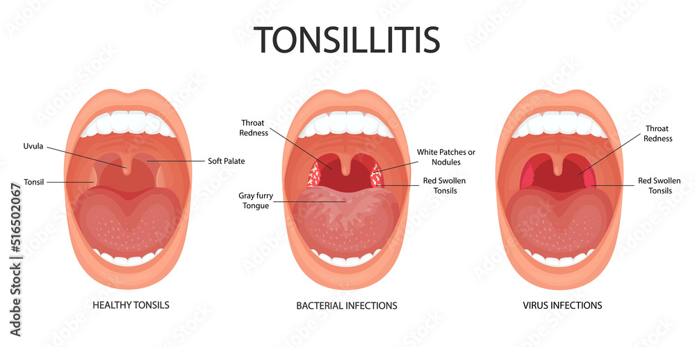Angina, pharyngitis and tonsillitis. Tonsillitis bacterial and viral. Tonsil infection. Open mouth, anatomy. Angina, pharyngitis and tonsillitis. Tonsillitis bacterial and viral. Tonsil infection. Open mouth, anatomy.