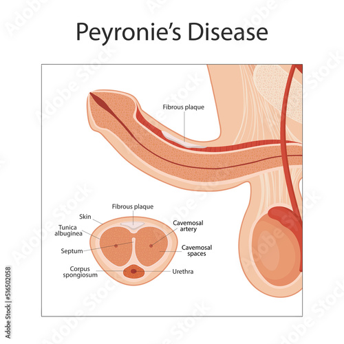 Peyronie disease. male reproductive system. penis medical vector illustration.