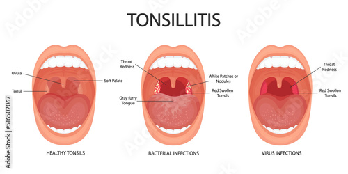 Angina, pharyngitis and tonsillitis. Tonsillitis bacterial and viral. Tonsil infection. Open mouth, anatomy.  photo