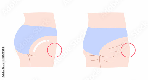 引き締まったお尻と垂れたお尻のイラストセット