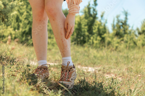 A woman scratches her legs with redness, irritation and pimples from insect bites. Close-up. The concept of protection against mosquitoes, ticks and fleas photo