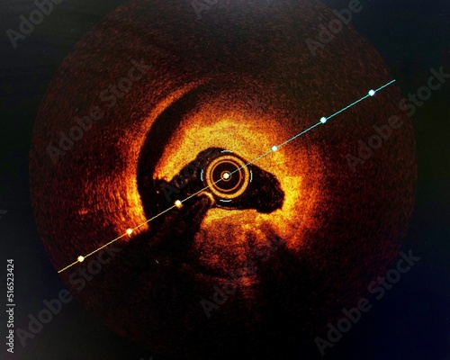 Canvas Print Intravascular imaging Optical Coherence Tomography (OCT) shown dissection in coronary artery