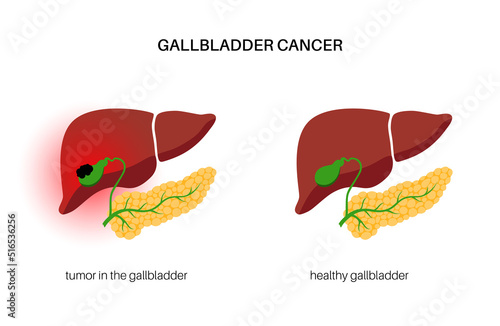 gallbladder cancer anatomy