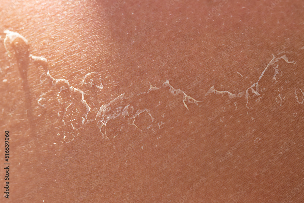 Fototapeta premium peeling of the skin after a sunburn as a background