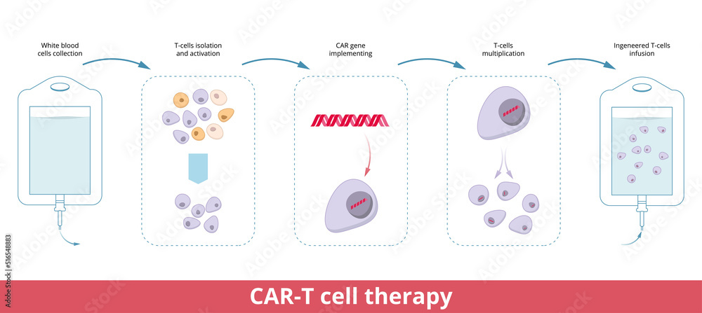 Plakat CAR-T cell therapy. Chimeric antigen receptor T cells (also ...