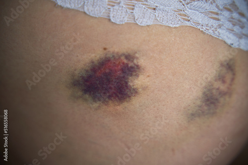 Close up of a hematoma on buttock after fall. A minor injury after sport activity appearing as a swollen area of discolored skin on the body photo