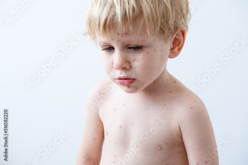Fotografie Chickenpox disease, portrait of blonde little boy with red rashes Chicken pox vi