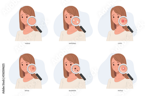 woman with magnifying glass close up type of acne.skin problem.skin care concept.acne problem.