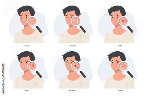 woman with magnifying glass close up type of acne.skin problem.skin care concept.acne problem.
