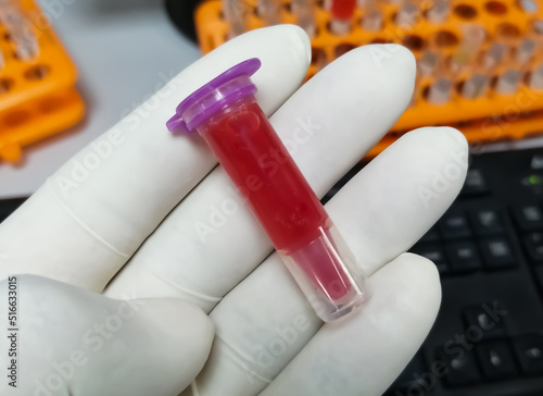 Scientist holding eppendorf with hemolyzed blood sample. Hemolysis sample can cause of false patient report. pre-analytical error.