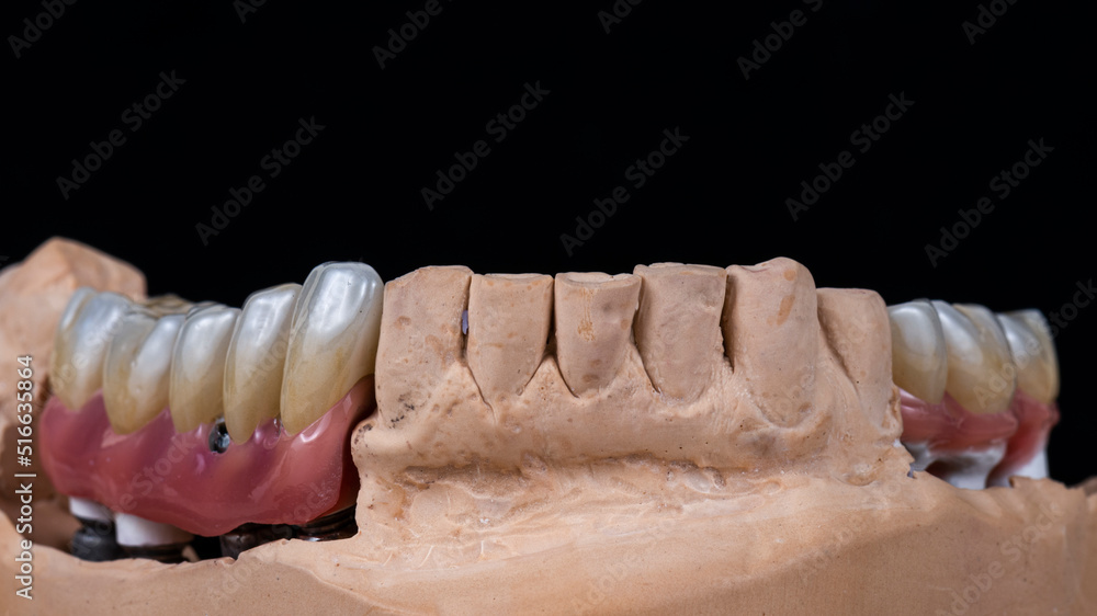 press ceramic crowns and veneers press ceramic crowns and veneers